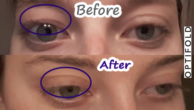 before-after-optifold-wide-lp1