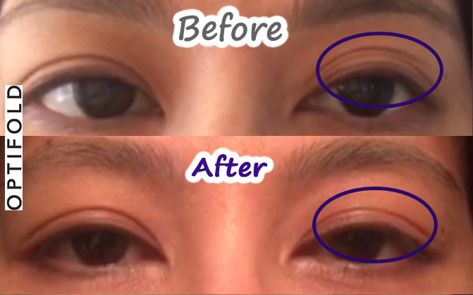 before-after-optifold-wide-lp2