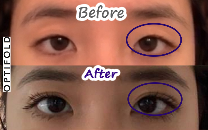 before-after-optifold-wide-lp3