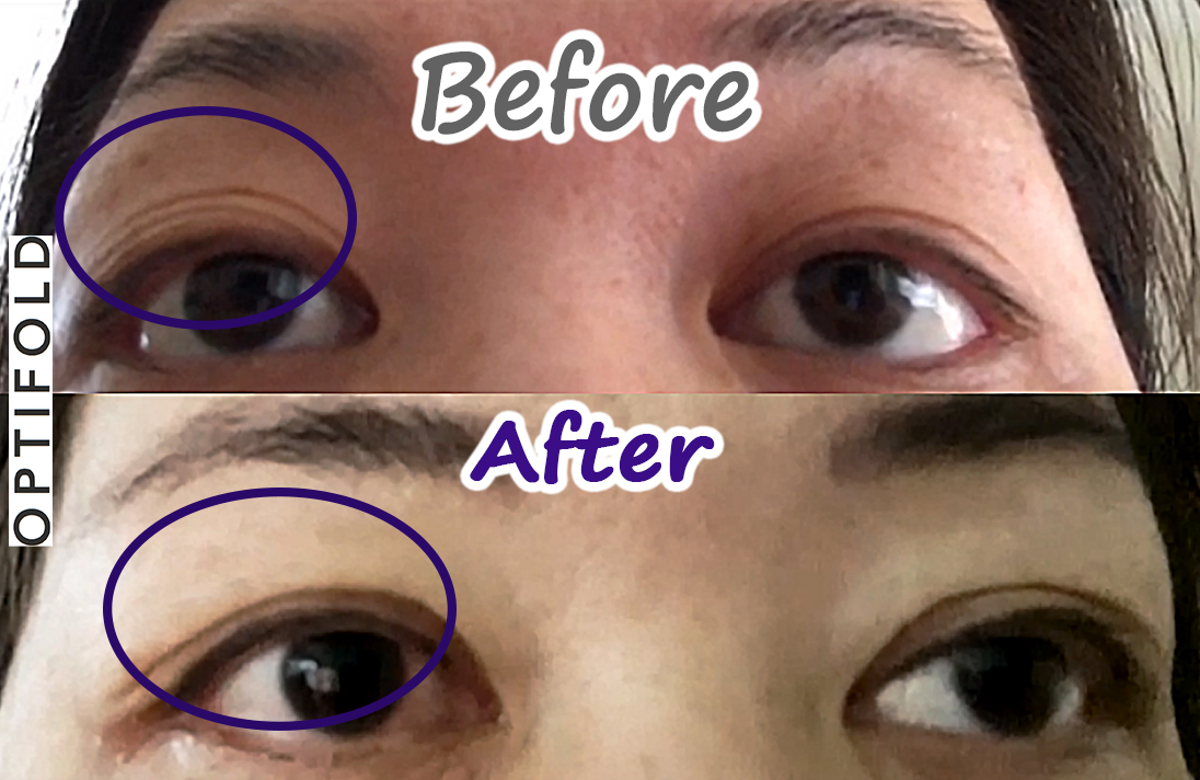 before-after-optifold-wide-lp4