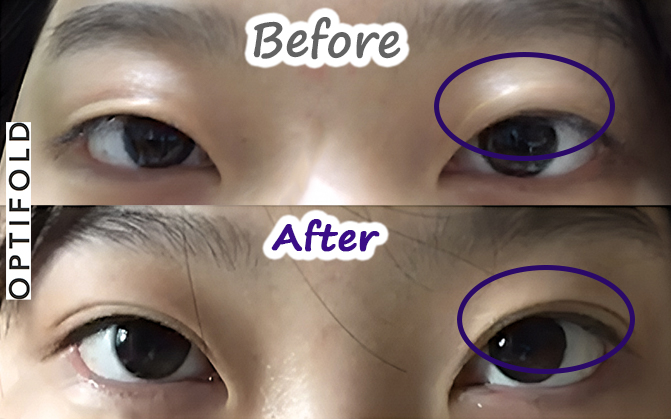 before-after-optifold-wide-lp7