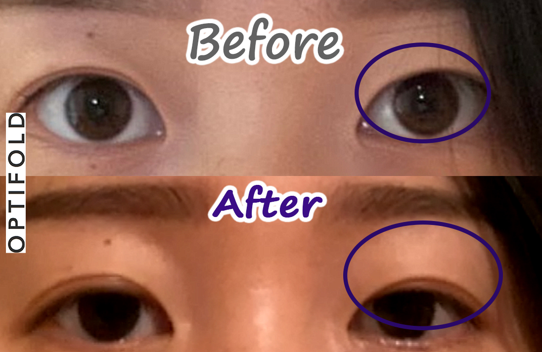 before-after-optifold-wide-lp8