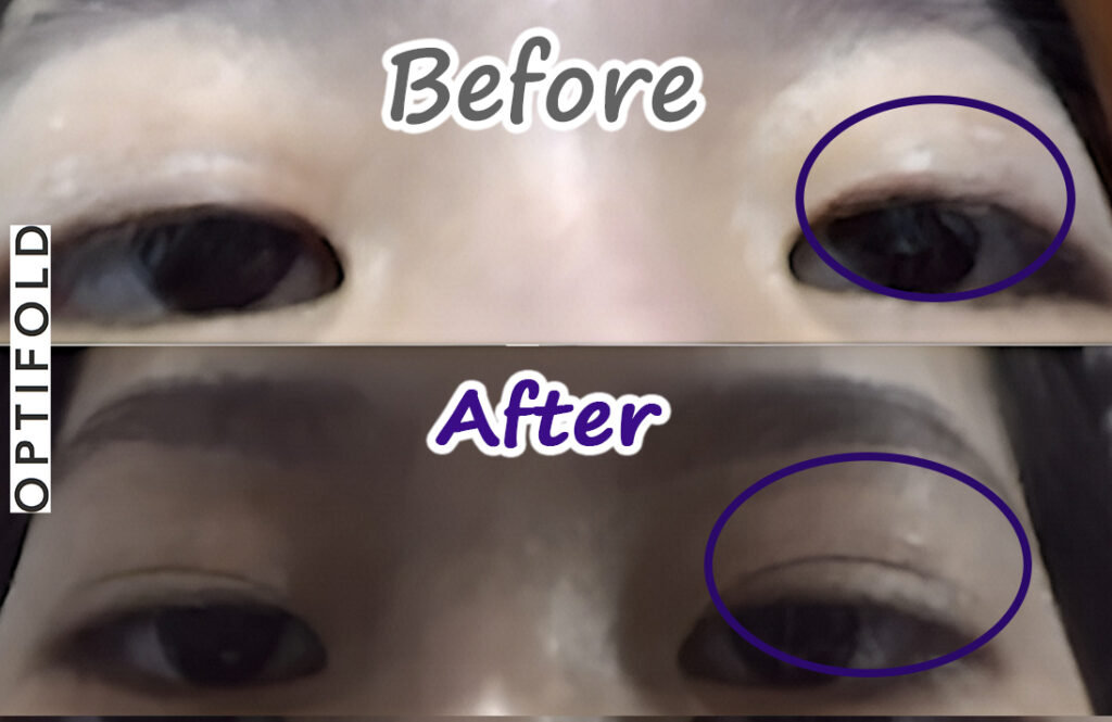optifold eyelid tapes create double eyelids and are safer than surgery
